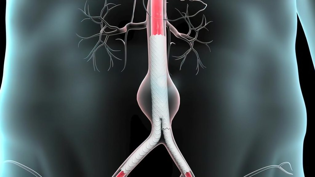 vigilancia-aneurisma-aorta-abdominal