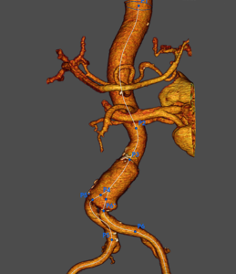 1-aneurisma-aorta-abdominal